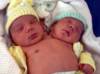 İkibaşlı uşaq doğuldu - FOTO
